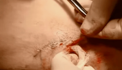 barizeak kentzeko eragiketa motak