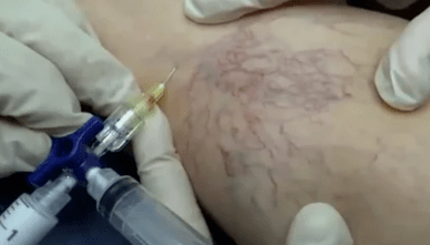 barizeetarako eskleroterapia